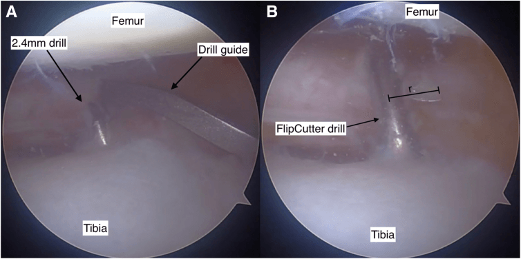 Arthroscopic root socket preparation with a 2.4 mm drill through a drill guide, then a FlipCutter drill