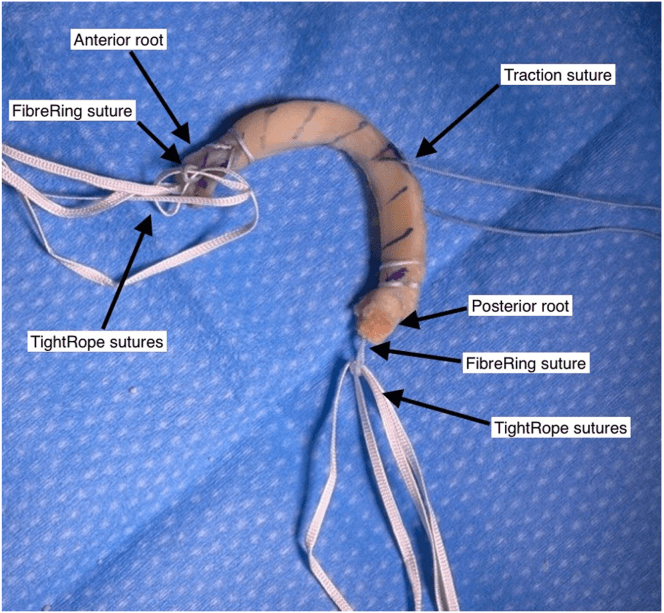 Prepared meniscal allograft with labelled root, FibreRing, TightRope and traction sutures