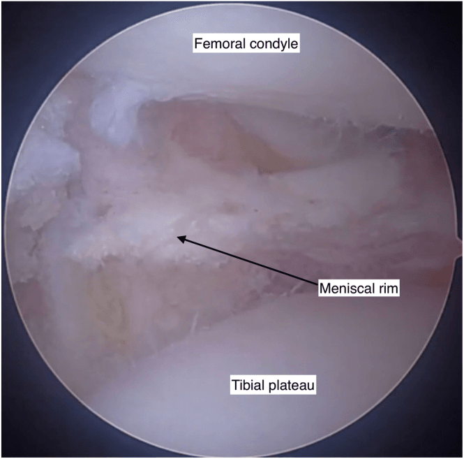 Arthroscopic view of the prepared recipient meniscal rim between femoral condyle and tibial plateau