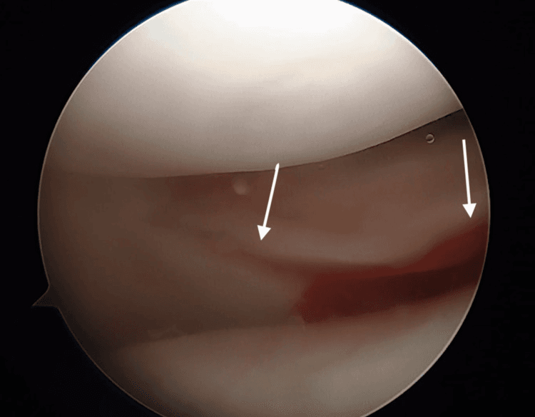 Arthroscopic view of a segmental meniscal deficiency marked by two arrows