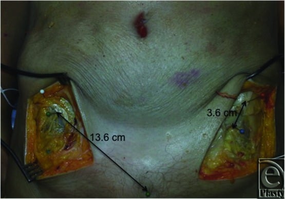 Bilateral dissection showing differing distances of the lateral femoral cutaneous nerve from the anterior superior iliac spine on each side