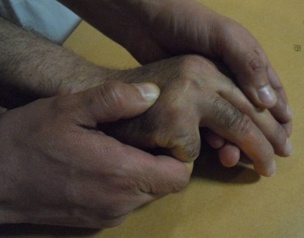 Clinical photograph demonstrating the Jahss manoeuvre, the fingers held flexed with the examiner's thumb over the dorsum of the hand