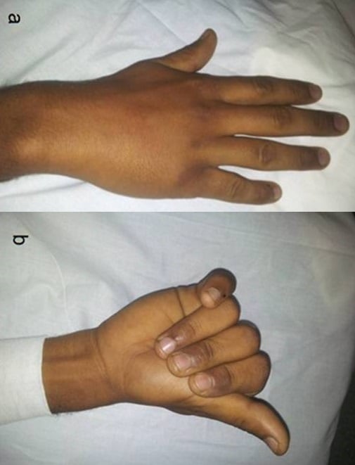 Clinical photographs showing rotational displacement of the fifth ray at rest and during finger flexion