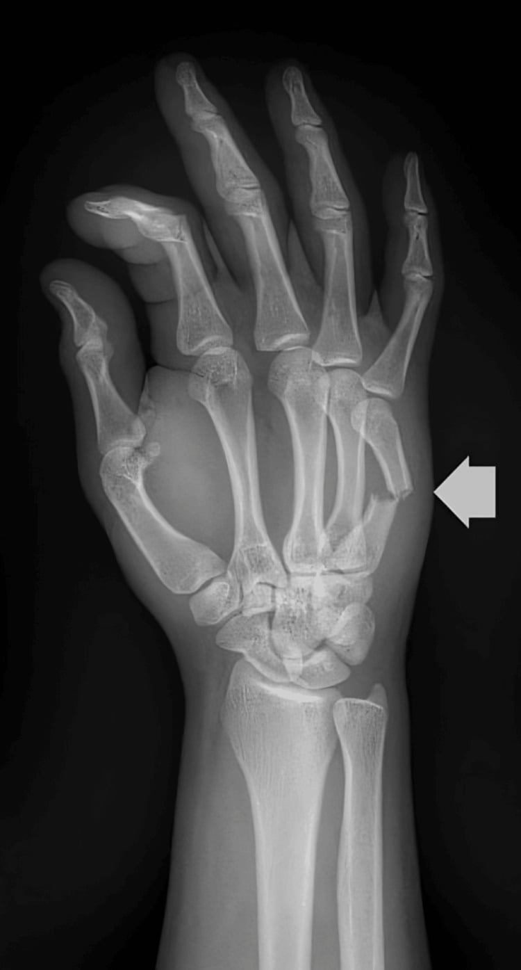 Hand radiograph showing a displaced fifth metacarpal shaft fracture