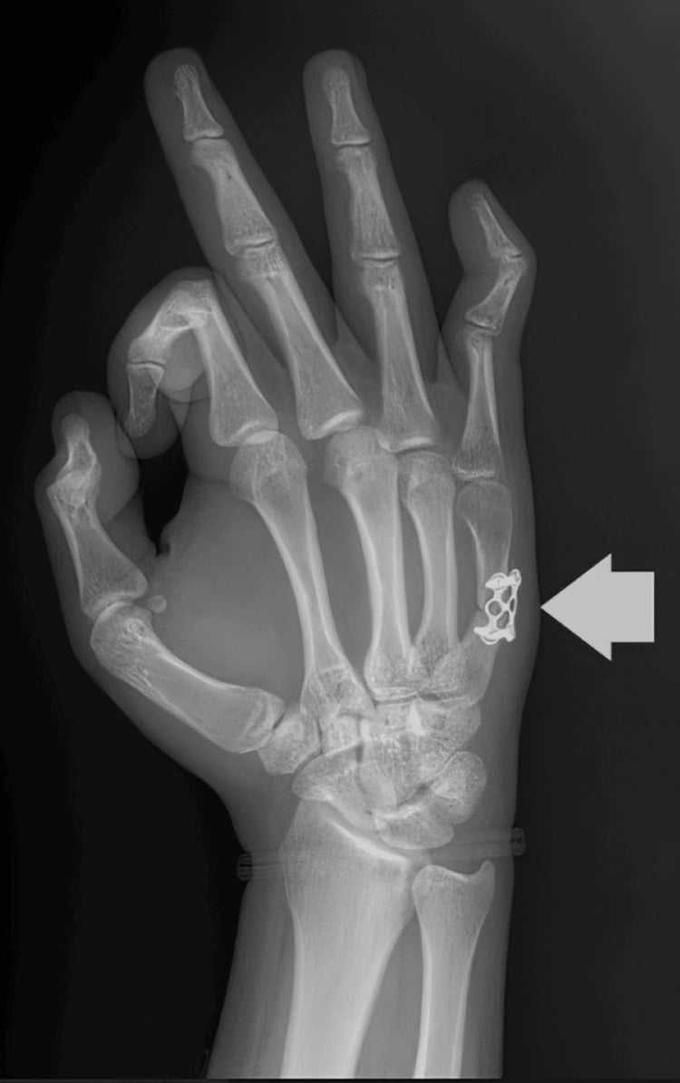 Radiograph showing plate fixation of a fifth metacarpal shaft fracture