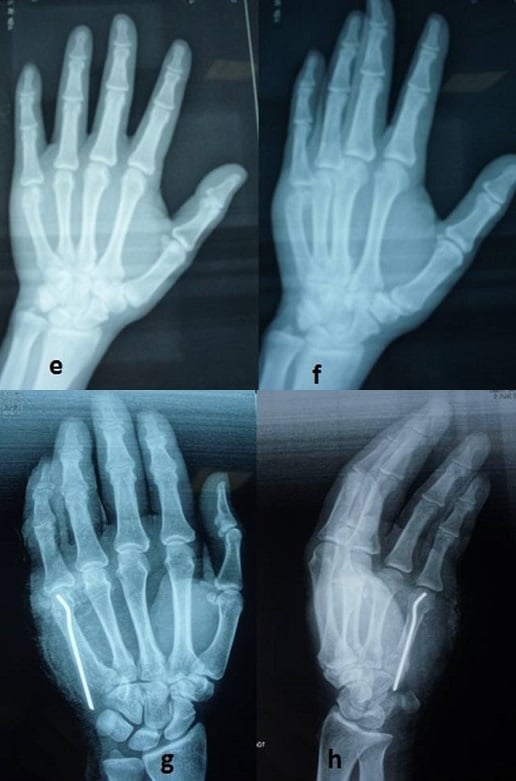 Preoperative and postoperative radiographs of a fifth metacarpal neck fracture treated with intramedullary K-wire fixation