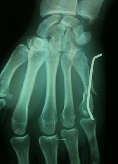 Radiograph showing backed-out intramedullary K-wire with loss of fifth metacarpal fracture reduction