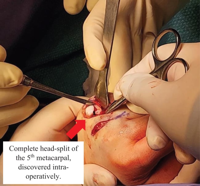 Intraoperative photograph showing a complete split fracture of the fifth metacarpal head