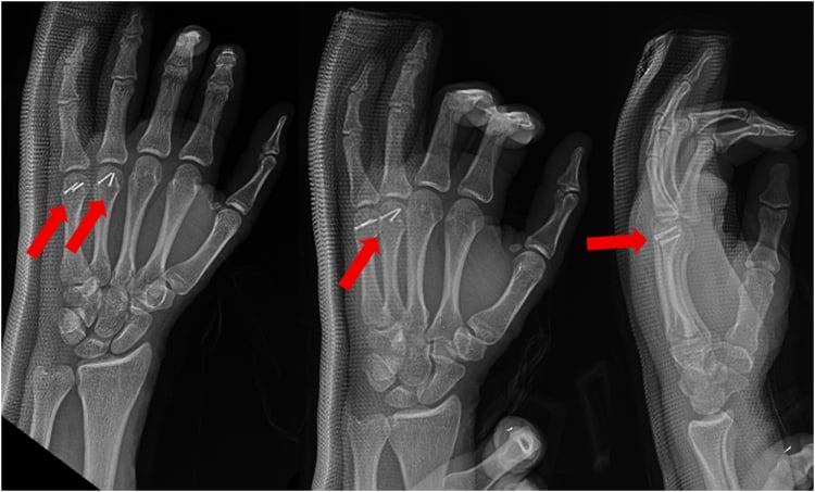 Postoperative radiographs showing reduced fourth and fifth metacarpal head fractures