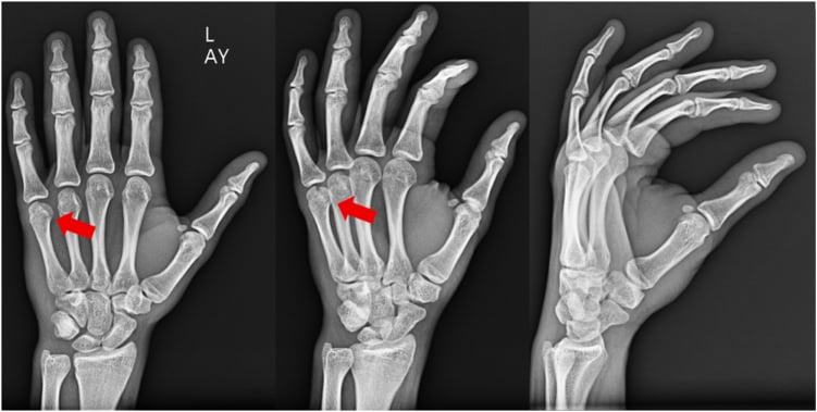 Posteroanterior, oblique and lateral hand radiographs, marked L, with red arrows at a metacarpal head fracture