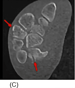Axial CT showing overlapping metacarpal bases and hamate avulsion in a multiple carpometacarpal fracture-dislocation