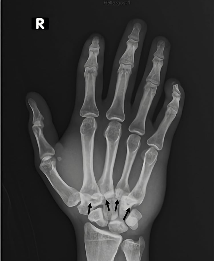 Posteroanterior radiograph showing fracture-dislocations of the second through fifth carpometacarpal joints