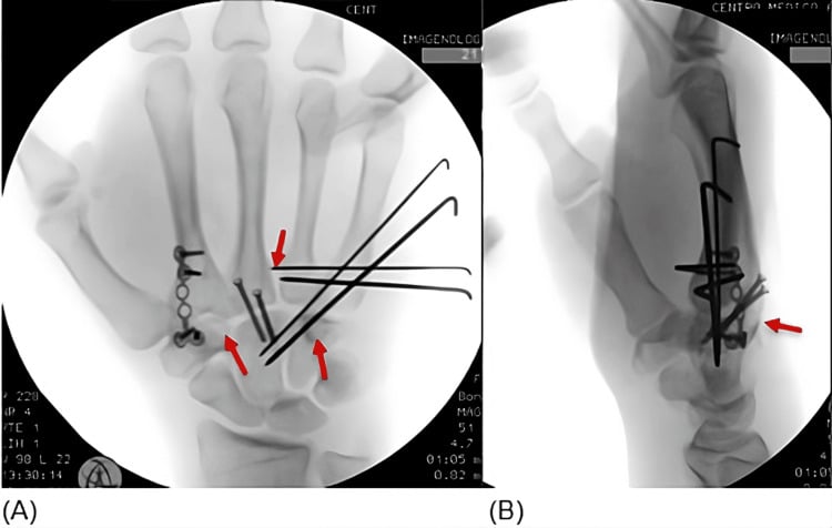 Fluoroscopic images showing K-wire and plate fixation with restored alignment of multiple carpometacarpal fracture-dislocations