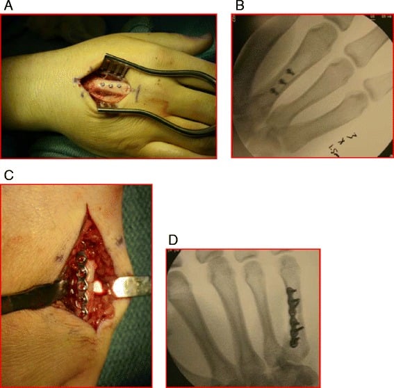 Operative and fluoroscopic images comparing lag-screw and plate fixation of metacarpal shaft fractures