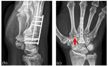 Two radiographic views showing plate fixation of a metacarpal base fracture and trapezoid–carpometacarpal dislocation