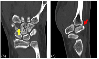 Coronal and sagittal CT images showing trapezoid and carpometacarpal disruption