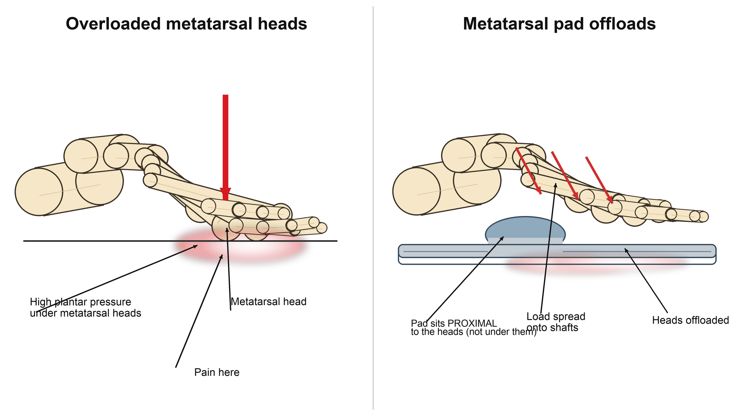 Diagram of metatarsal head overload causing metatarsalgia and how a metatarsal pad offloads the heads.