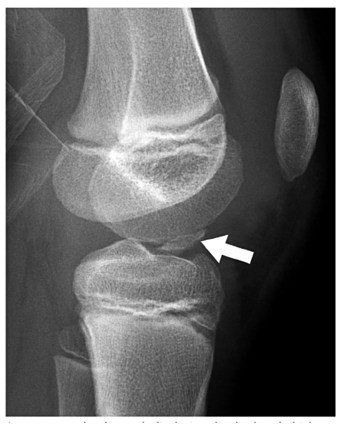 Lateral knee radiograph of a skeletally immature patient showing a displaced tibial spine (eminence) avulsion fragment (arrow), with open physes.