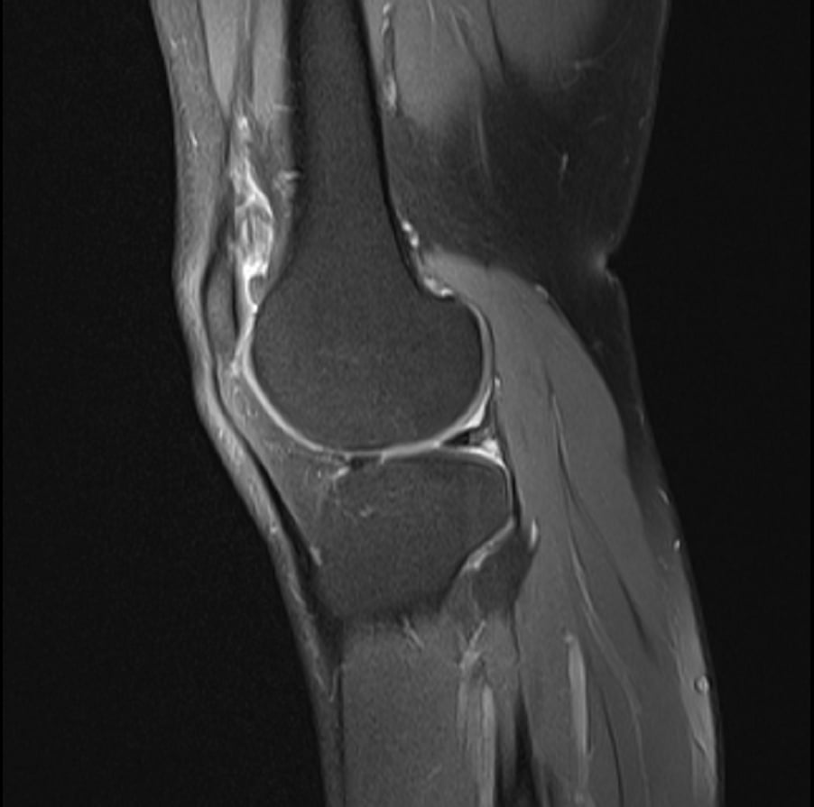 Sagittal fat-suppressed proton-density MRI of the knee showing the femur, tibia, joint space and cruciate region.