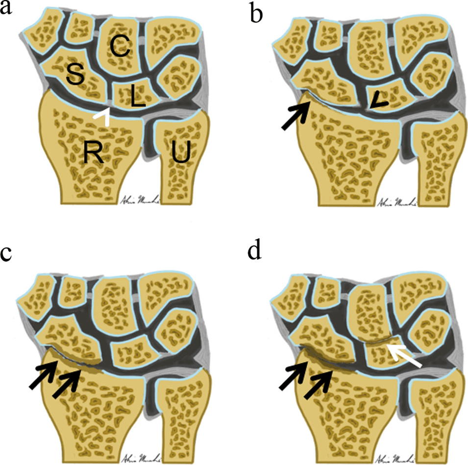 Coronal illustrations of the wrist showing the progressive osteoarthritic staging of SLAC arthropathy from normal through Stage III