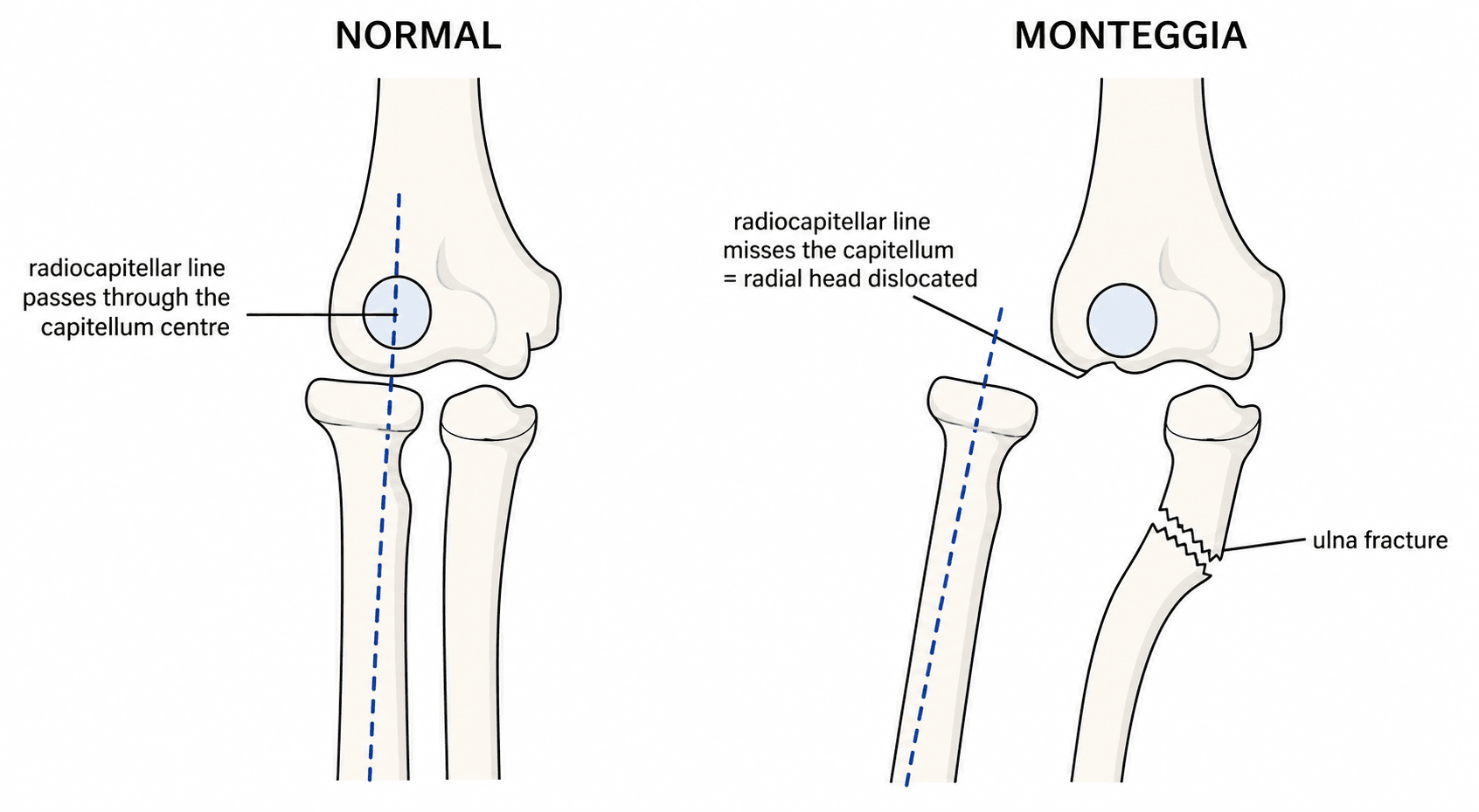Schematic comparing a normal elbow, where the radiocapitellar line passes through the capitellum centre, with a Monteggia fracture-dislocation, where an angulated ulna fracture displaces the radial head so the same line misses the capitellum.