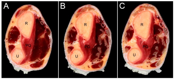 Three serial transverse sections of the distal forearm (A-C) with radius, ulna and pronator quadratus labelled and an arrowhead on the interosseous membrane
