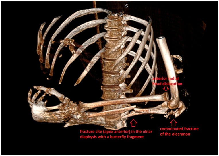 Three-dimensional CT reconstruction of a comminuted Monteggia fracture-dislocation