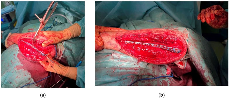 Operative views of provisional and definitive ulnar plate fixation in Monteggia injury