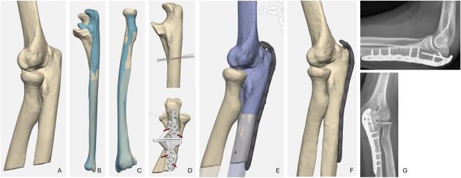 Three-dimensional planning and postoperative radiographs for chronic Monteggia deformity correction