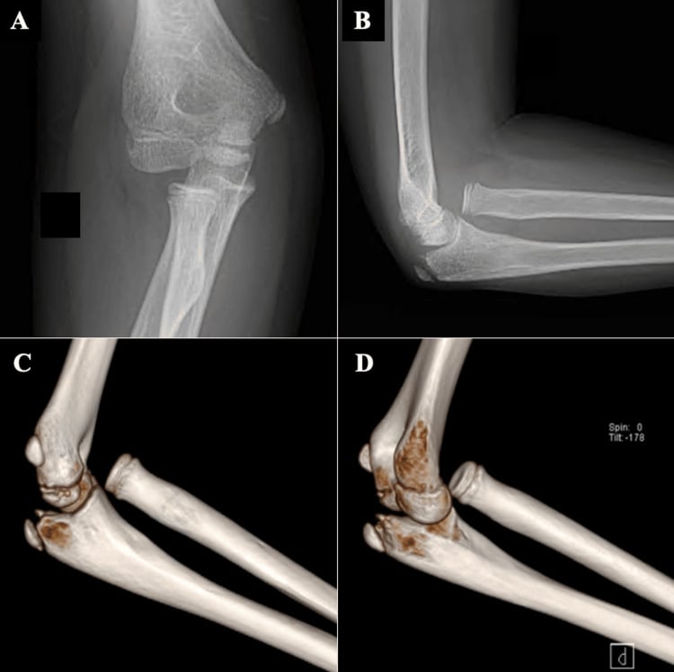 Radiographs and three-dimensional CT of an irreducible radial-head dislocation