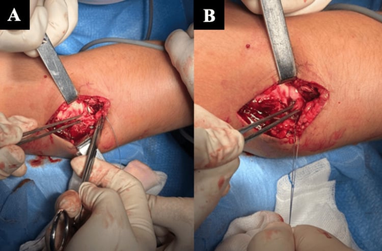 Operative identification and reattachment of an interposed annular ligament