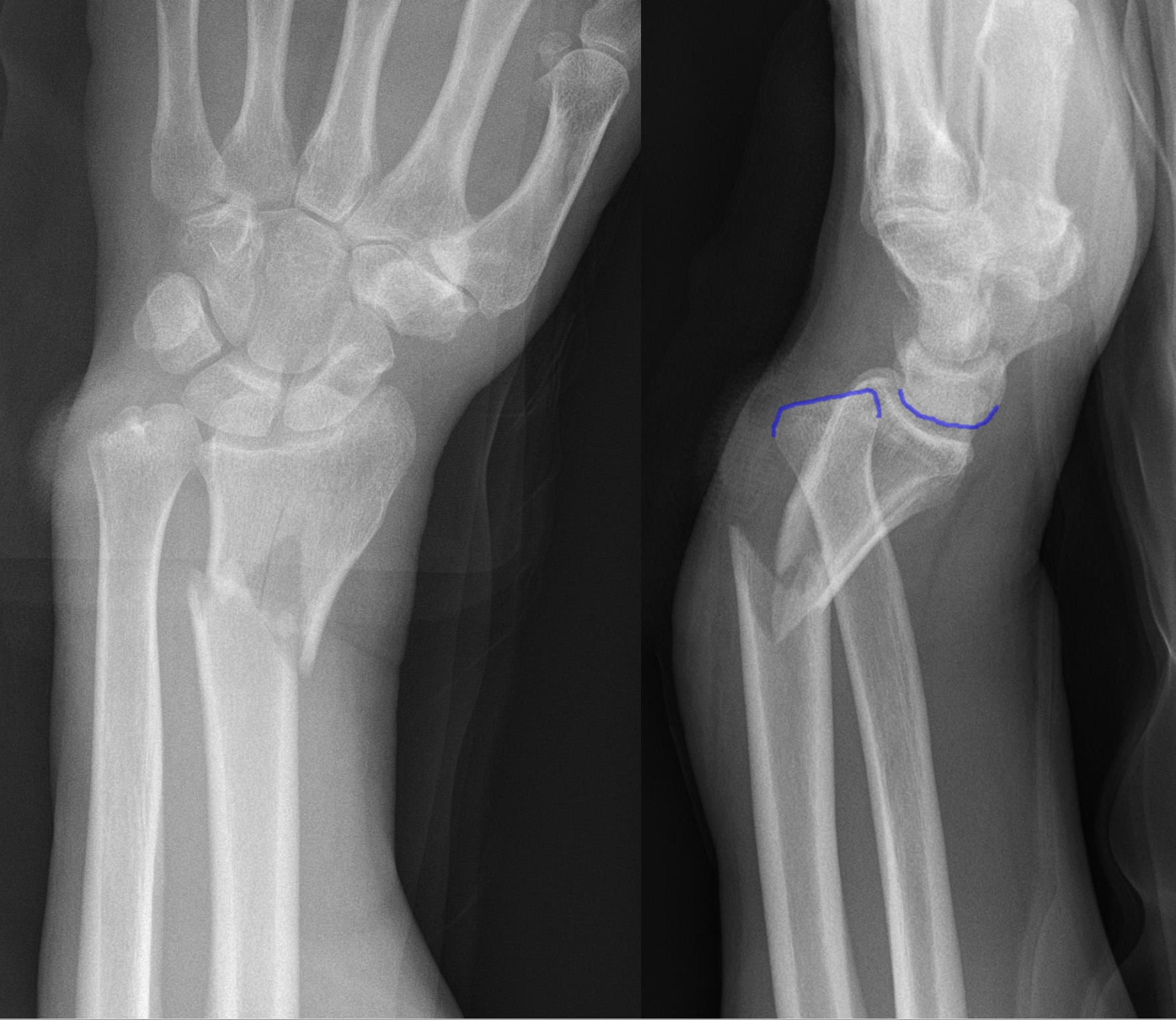 AP and lateral radiographs of a Galeazzi fracture-dislocation with the DRUJ outlined