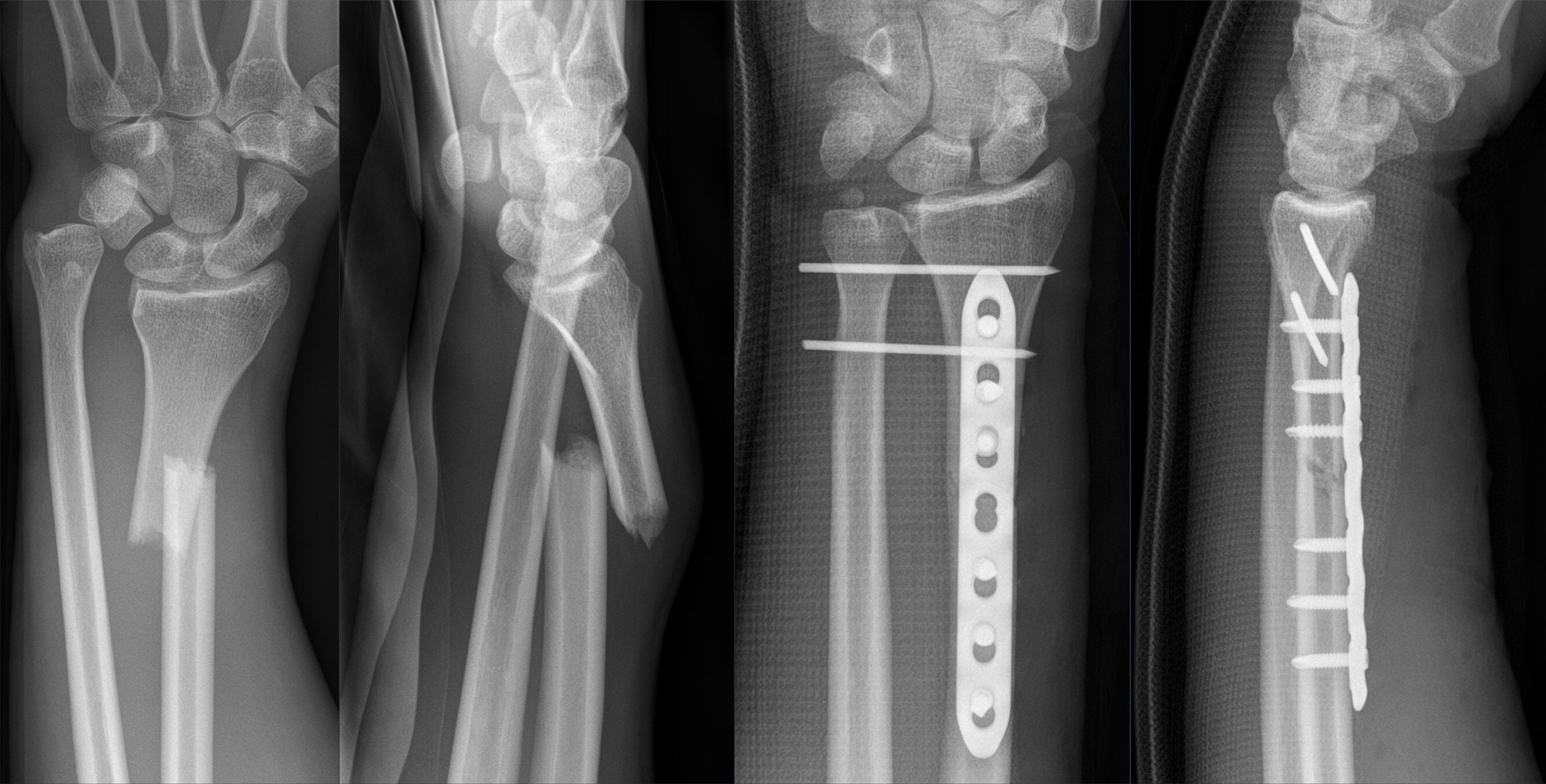 Preoperative and postoperative Galeazzi radiographs with radial plating and DRUJ transfixion