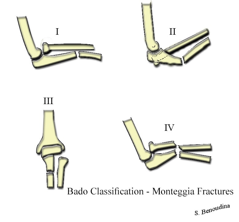 Bado classification of Monteggia fracture-dislocations