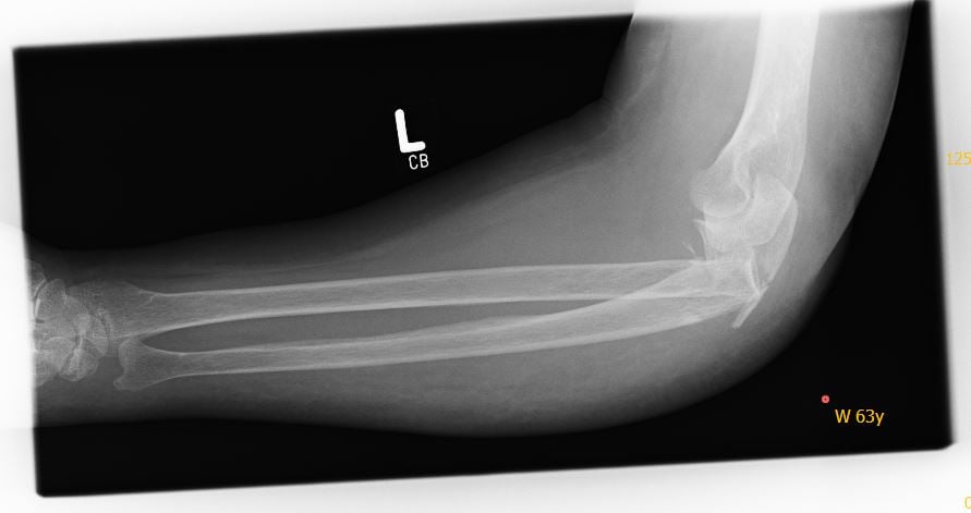 Adult lateral radiograph showing a posterior Monteggia fracture-dislocation