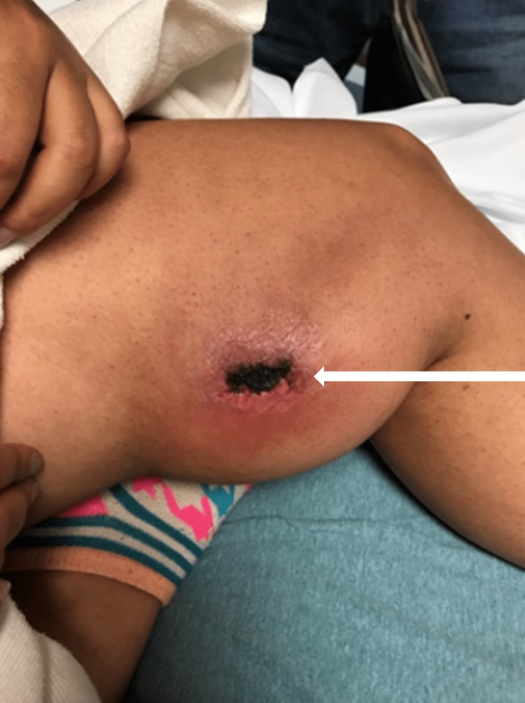 Clinical photograph of a Morel-Lavallee lesion with swelling, erythema and central necrotic skin change