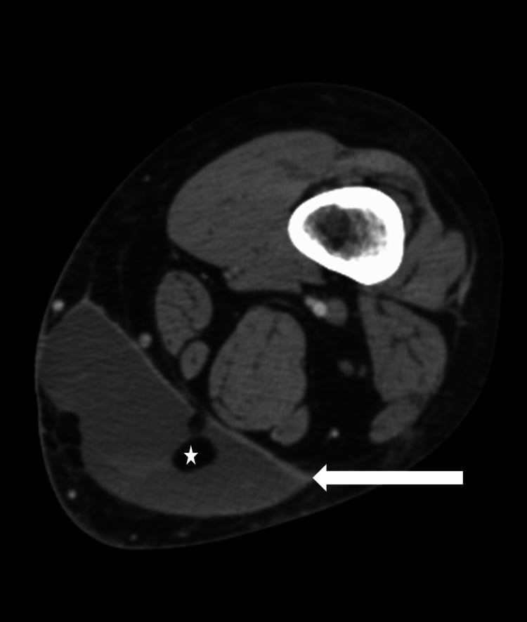 Axial CT image showing Morel-Lavallee fluid collection superficial to fascia