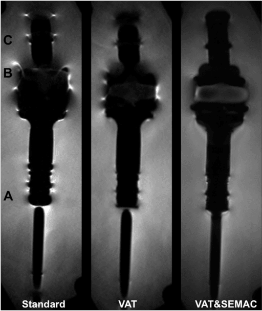 MRI artefact reduction techniques demonstrating improved imaging around orthopaedic metal