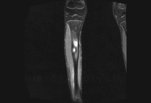 Coronal STIR MRI of the leg showing bright bone marrow and peritumoral oedema