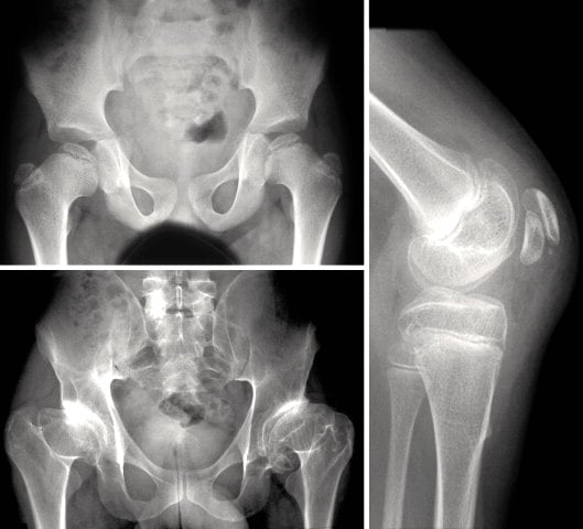 Radiographs of the hips and knee in multiple epiphyseal dysplasia showing symmetric small, irregular and fragmented epiphyses at multiple joints.