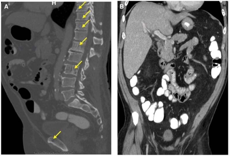 Whole-body low-dose CT showing multiple vertebral lytic lesions in multiple myeloma.
