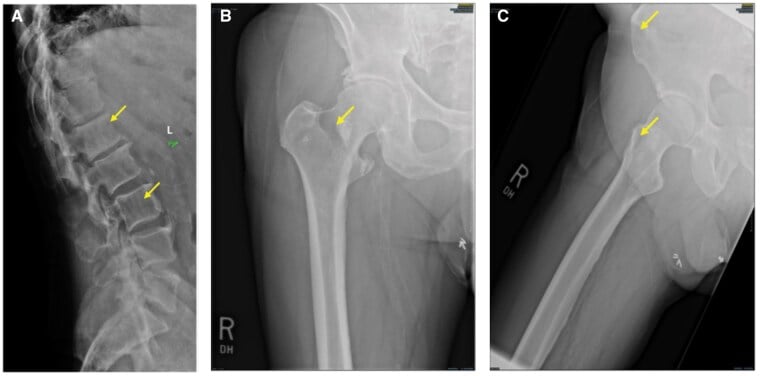 Skeletal survey radiographs showing destructive lytic lesions in lumbar vertebrae, femoral neck and iliac crest.