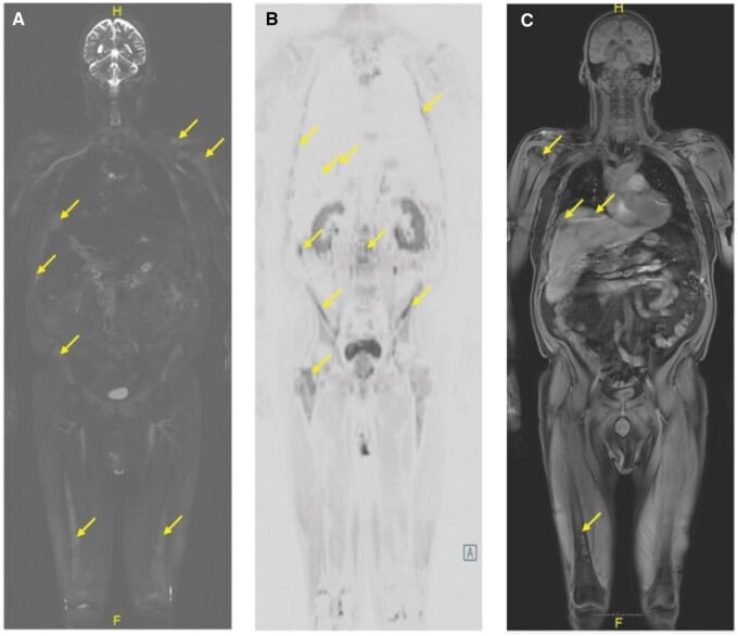 Whole-body MRI showing widespread skeletal and hepatic multiple myeloma lesions.