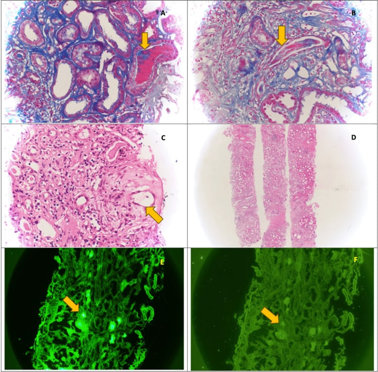 Renal biopsy showing polychromatic fractured casts in myeloma cast nephropathy.