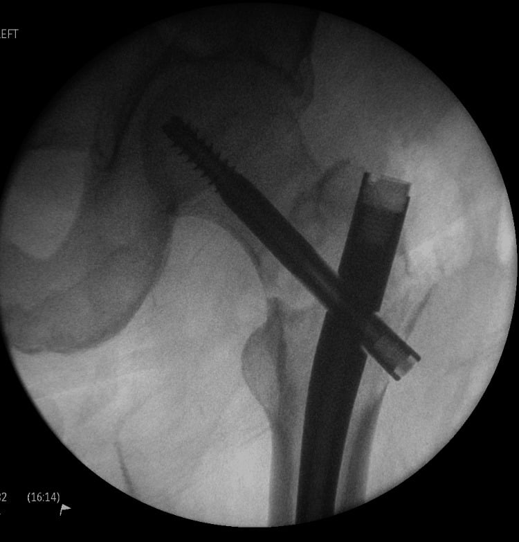 Intraoperative fluoroscopy of long cephalomedullary nail fixation for a pathological proximal femur fracture.