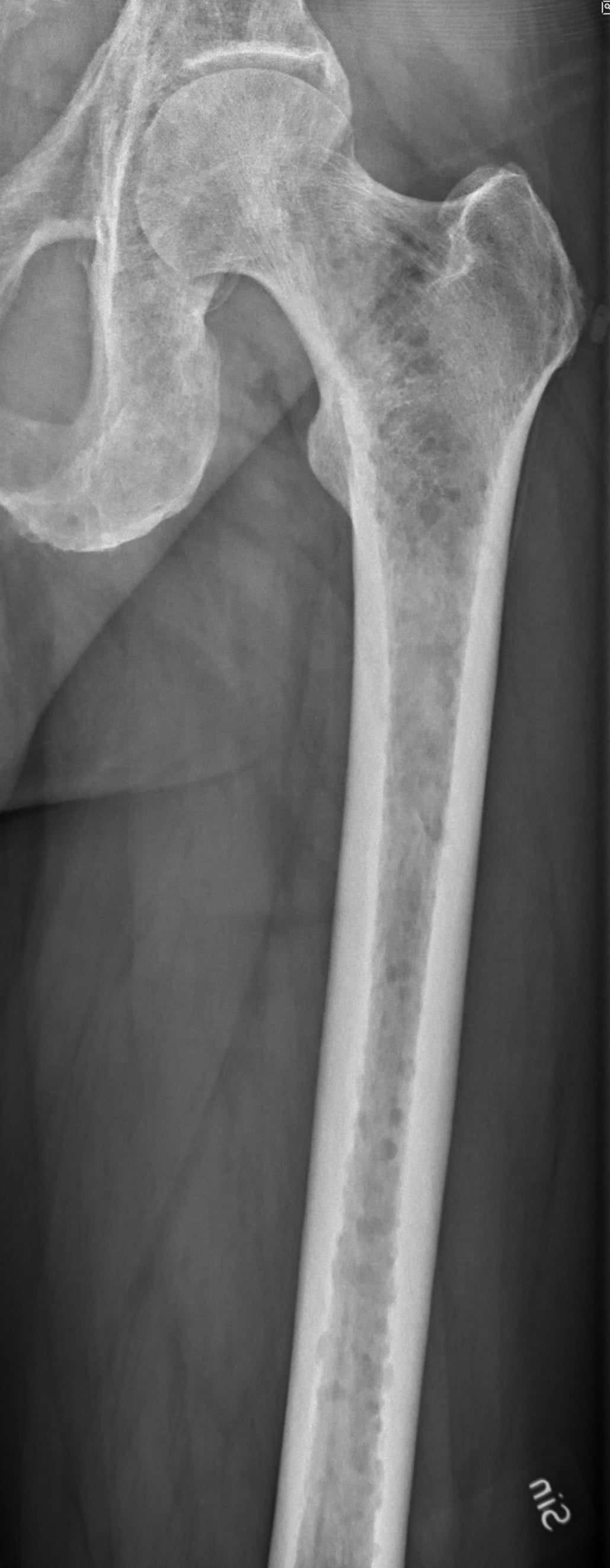 Radiograph of the proximal femur showing multiple punched-out lytic lesions of multiple myeloma.