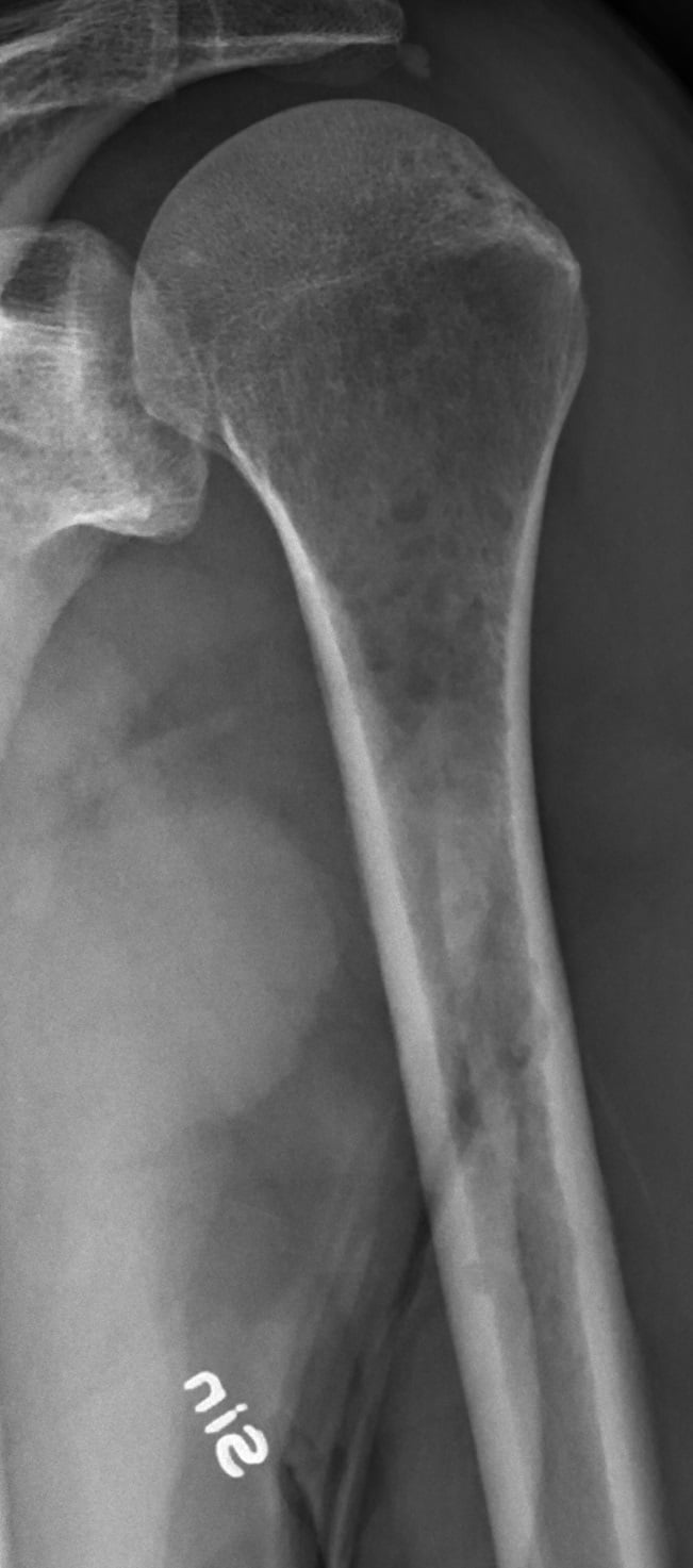 Radiograph of the proximal humerus showing lytic myeloma lesions.