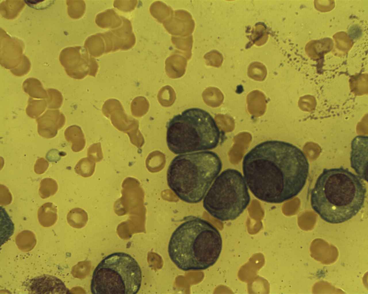 Bone marrow film in multiple myeloma showing a cluster of malignant plasma cells with eccentric nuclei among red cells in rouleaux.