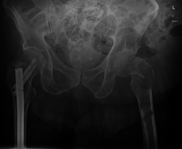 Pelvic radiograph showing a pathological left intertrochanteric fracture in multiple myeloma and a prior right cephalomedullary nail.