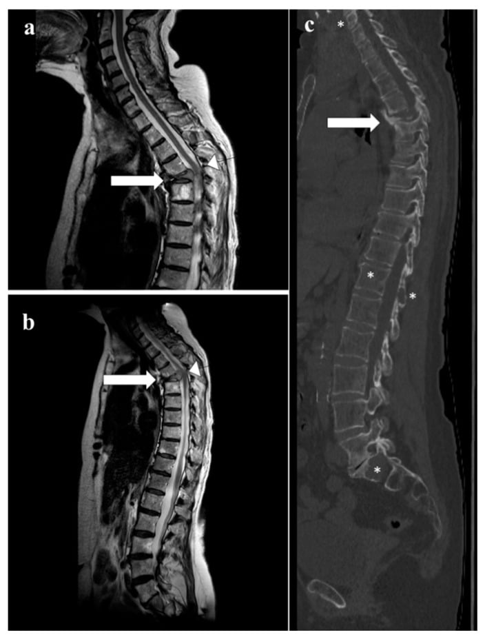Sagittal MRI and CT showing a myeloma pathological T5 fracture with vertebra plana and spinal cord compression.